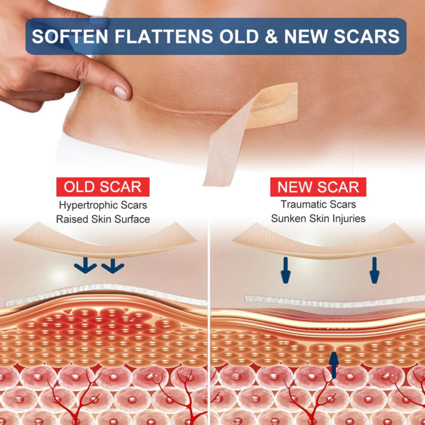 Silicone scar sheets