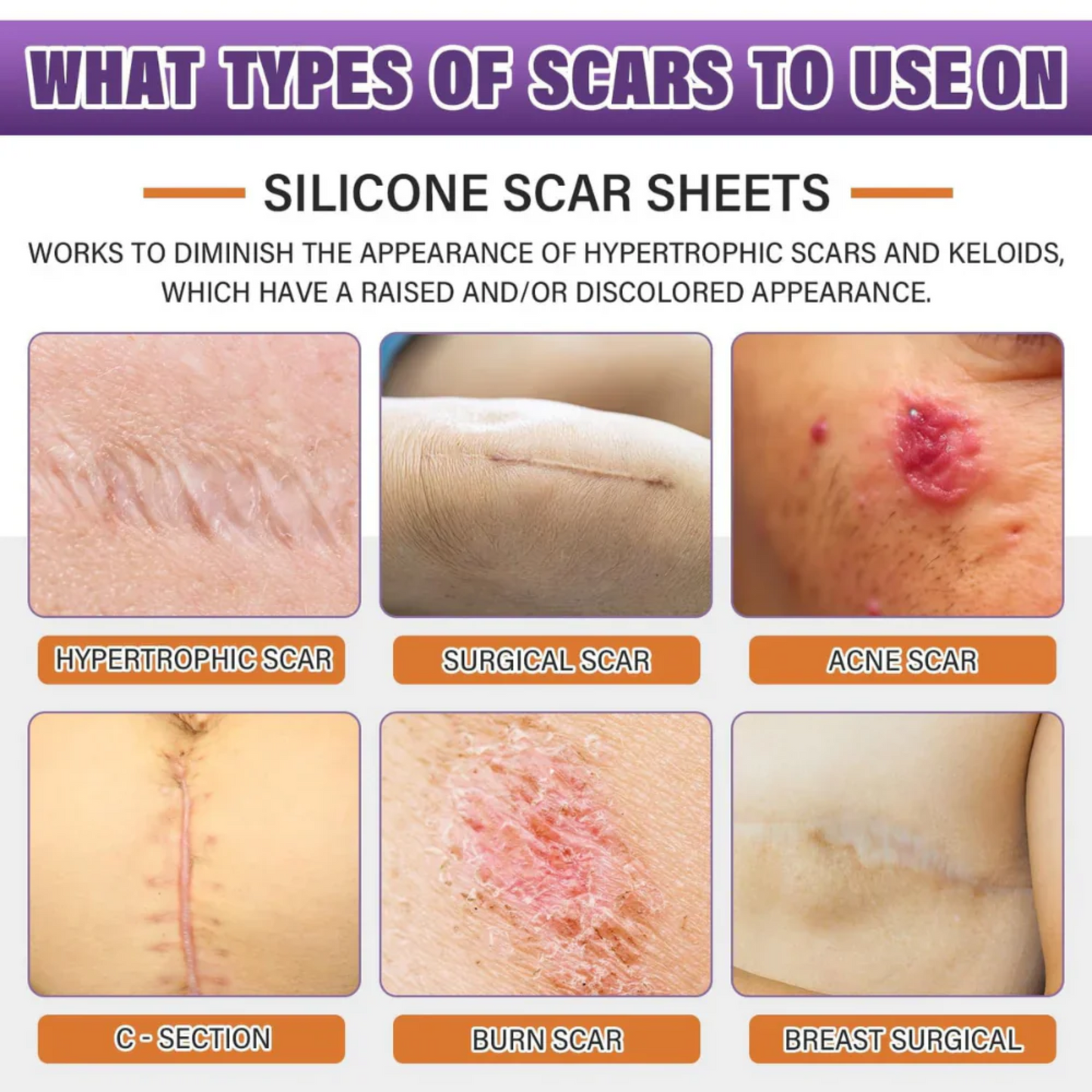 Silicone scar sheets